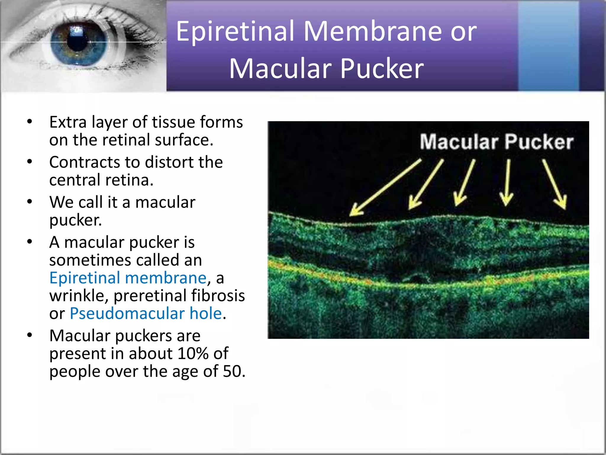 Epiretinal Membrane or
Macular Pucker
• Extra layer of tissue forms
on the retinal surface.
• Contracts to distort the
central retina.
• We call it a macular
pucker.
• A macular pucker is
sometimes called an
Epiretinal membrane, a
wrinkle, preretinal fibrosis
or Pseudomacular hole.
• Macular puckers are
present in about 10% of
people over the age of 50.
 