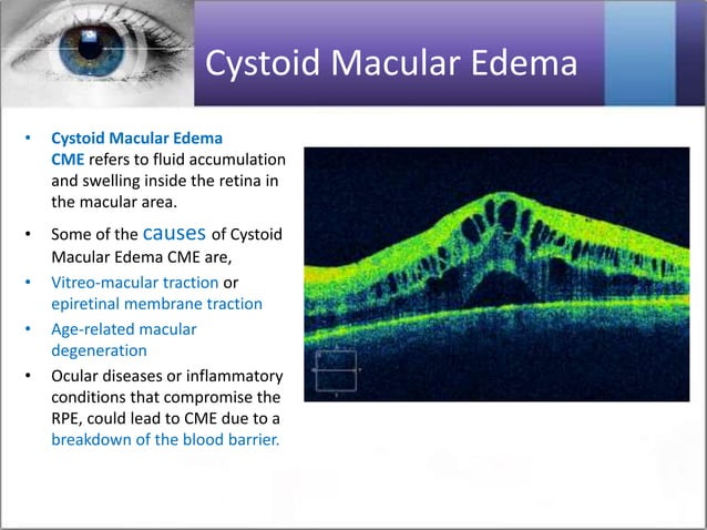 Optical/ocular coherence tomography OCT All in one Presentation | PPTX ...