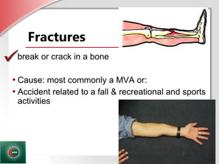 © Business & Legal Reports, Inc. 1110
Fractures
A break or crack in a bone
• Cause: most commonly a MVA or:
• Accident related to a fall & recreational and sports
activities
 