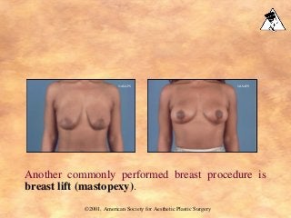 Another commonly performed breast procedure is
breast lift (mastopexy).
©2001, American Society for Aesthetic Plastic Surgery
©ASAPS ©ASAPS
 
