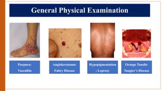 General Physical Examination
Purpura:
Vasculitis
Angiokeratoma:
Fabry Disease
Hypopigmentation
: Leprosy
Orange Tonsils:
Tangier’s Disease
 