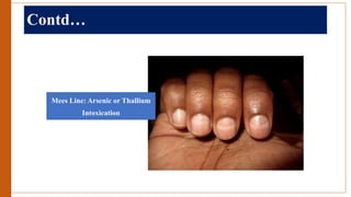 Contd…
Mees Line: Arsenic or Thallium
Intoxication
 
