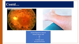 Contd…
Retinitis Pigmentosa, Icthyosis
Refsum’s Disease (AR)
• RP
• PN
• Cerebellar Ataxia
• Elevated CSF Protein
 