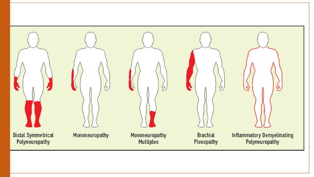 Approach to Peripheral Neuropathy