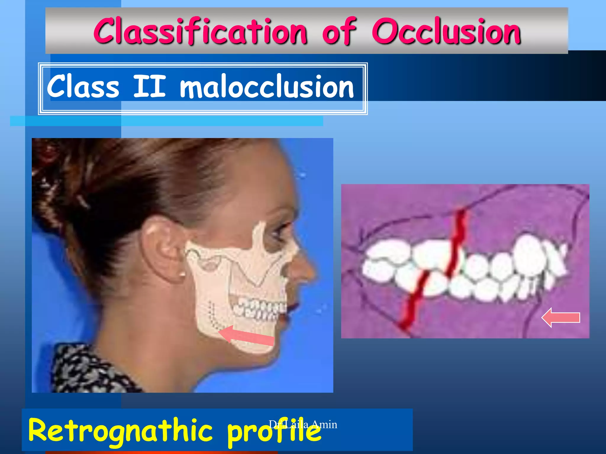 Dr laila Amin (occlusion2) | PPTX