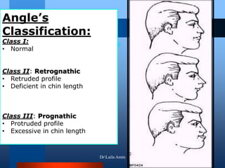 Angle’s
Classification:
Class I:
• Normal
Class II: Retrognathic
• Retruded profile
• Deficient in chin length
Class III: Prognathic
• Protruded profile
• Excessive in chin length
DrLaila Amin
 