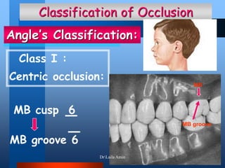MB cusp 6
MB groove 6
Classification of Occlusion
Class I :
Centric occlusion:
Angle’s Classification:
MB
MB groove
DrLaila Amin
 
