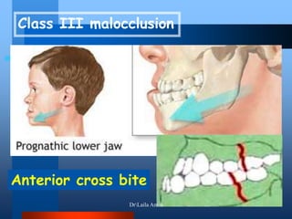Class III malocclusion
Anterior cross bite
DrLaila Amin
 