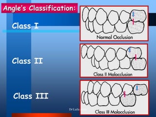 Class I
Class II
Class III
Angle’s Classification:
DrLaila Amin
 