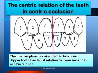The centric relation of the teeth
in centric occlusion
The median plane is coincident in two jaws
Upper tooth has labial relation to lower incisor in
centric relation
DrLaila Amin
 