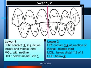 Lower 1, 2
Lower 1
LI R: contact 1 at junction
incisal and middle third
MOL: with midline
DOL: below mesial 23 1
Lower 2
LIR: contact 1,2 at junction of
incisal , middle third
MOL: below distal 13 of 1
DOL: below 2
DrLaila Amin
 