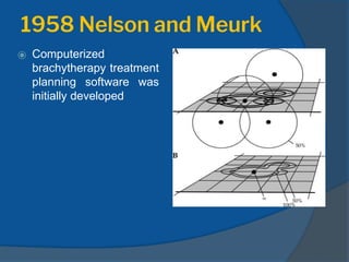 1958 Nelson and Meurk
⦿ Computerized
brachytherapy treatment
planning software was
initially developed
 