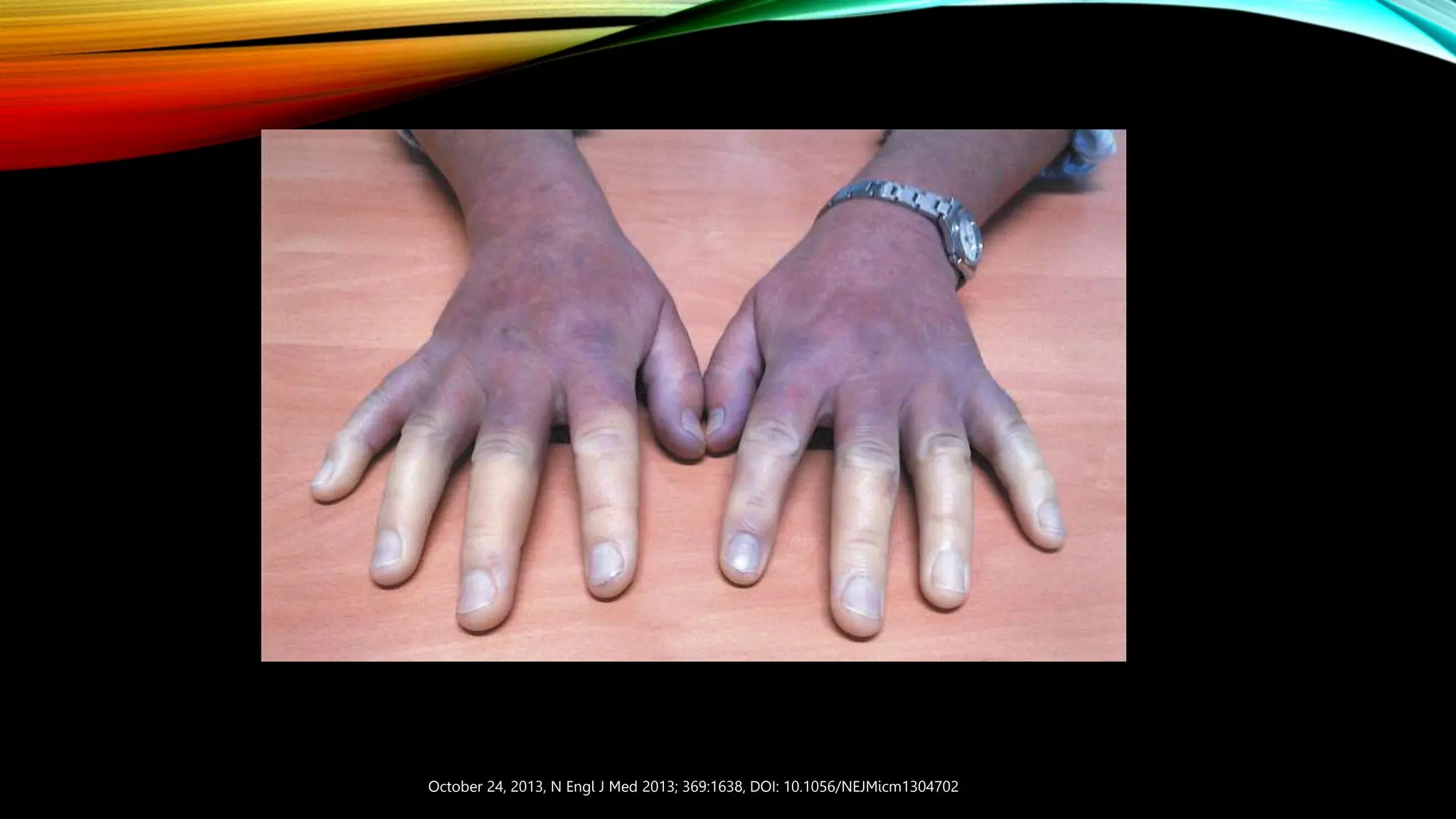 Scleroderma: Treatment Options and a Look to the Future - Dr. Macklin | PPT