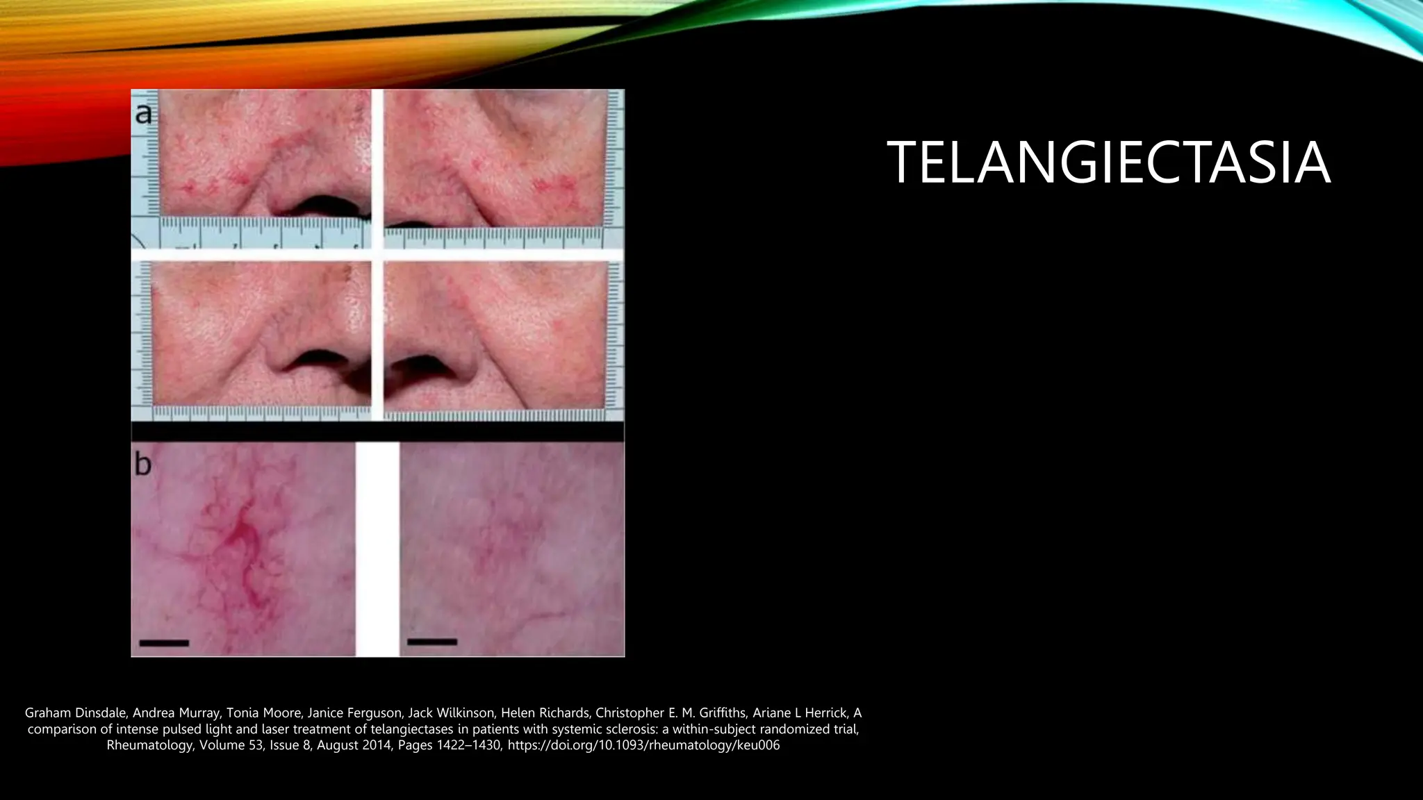 Scleroderma: Treatment Options and a Look to the Future - Dr. Macklin | PPT