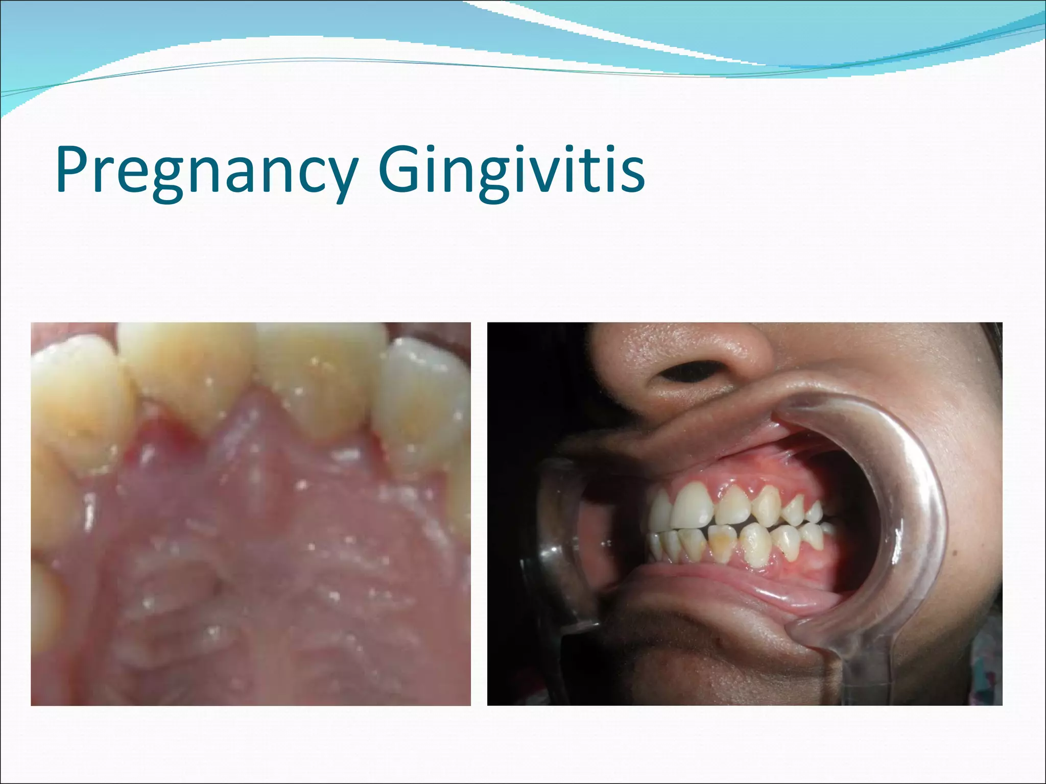 Pregnancy Gingivitis 