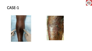 COMPARTMENT SYNDROME IN TIBIAL FRACTURES AND PERCUTANEOUS MINI OPEN ...