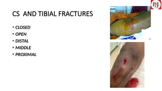 COMPARTMENT SYNDROME IN TIBIAL FRACTURES AND PERCUTANEOUS MINI OPEN ...