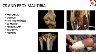 COMPARTMENT SYNDROME IN TIBIAL FRACTURES AND PERCUTANEOUS MINI OPEN ...