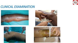 COMPARTMENT SYNDROME IN TIBIAL FRACTURES AND PERCUTANEOUS MINI OPEN ...