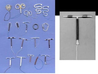 Iud Rame Drm science lecture 2 CONTRACEPTIVES AND IUDs | PPTX