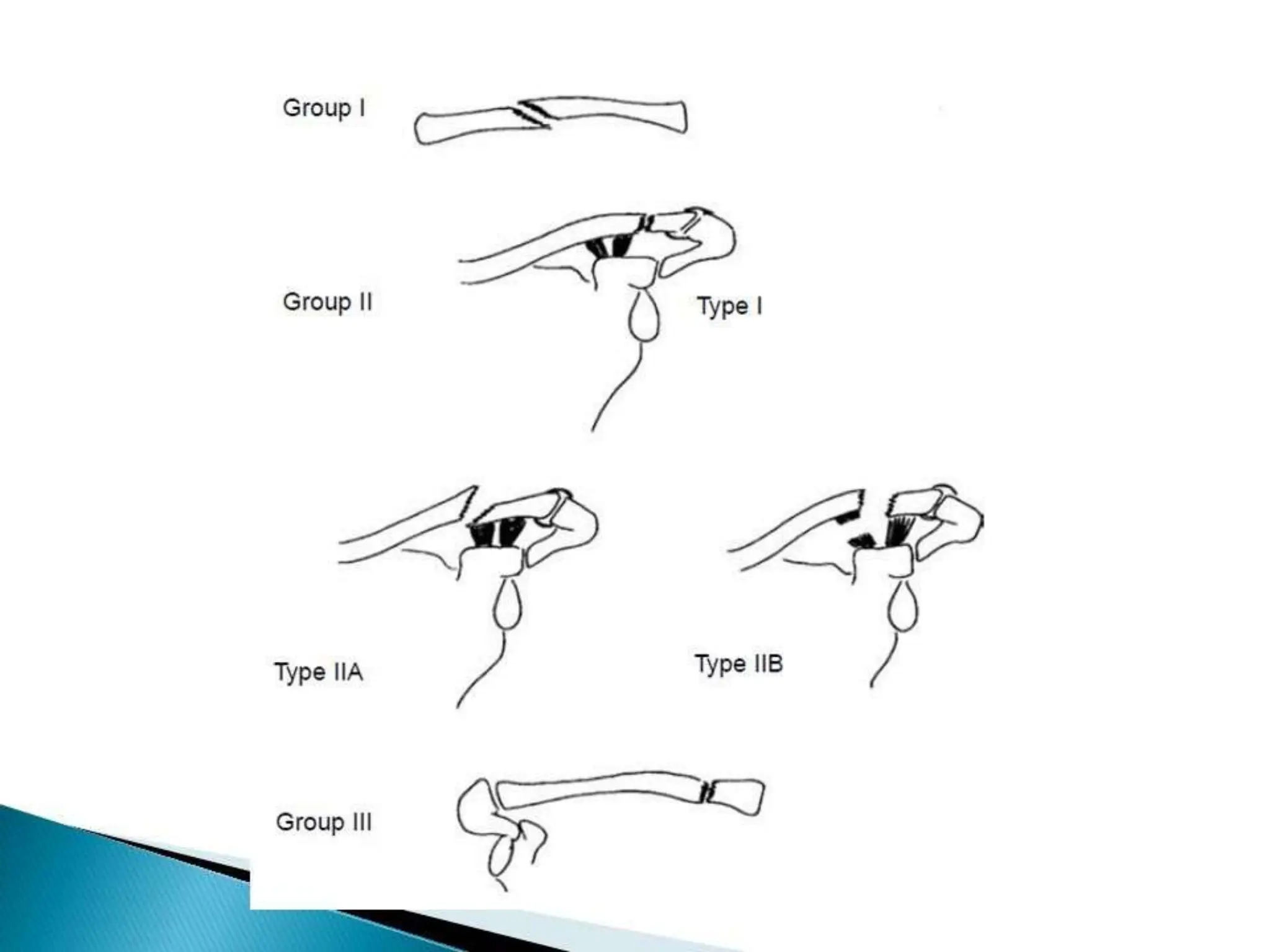 Dr Naveed clavicle fracture classification | PPTX