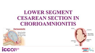 LOWER SEGMENT
CESAREAN SECTION IN
CHORIOAMNIONITIS
 