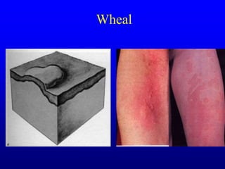 Wheals Examples Dr Nzau Skin Lesions.ppt