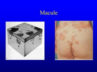 Macule Most Common Example Dr Nzau Skin Lesions.ppt