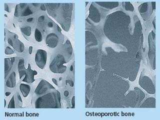 Bone Health, Falls Prevention and Falls Reduction Strategies - AIGNA ...