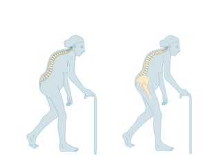 Bone Health, Falls Prevention and Falls Reduction Strategies - AIGNA ...