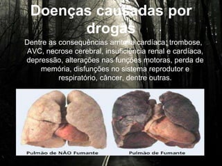 Doenças causadas por
drogas
Dentre as consequências arritmia cardíaca, trombose,
AVC, necrose cerebral, insuficiência renal e cardíaca,
depressão, alterações nas funções motoras, perda de
memória, disfunções no sistema reprodutor e respiratório,
câncer, dentre outras.
 