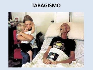 TABAGISMO 
 