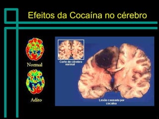 Efeitos da Cocaína no cérebroEfeitos da Cocaína no cérebro
 