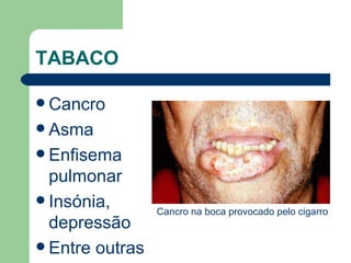 TABACO    Cancro Asma Enfisema pulmonar  Insónia, depressão  Entre outras Cancro na boca provocado pelo cigarro 