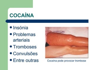 COCAÍNA  Insónia  Problemas arteriais  Tromboses  Convulsões  Entre outras Cocaína pode provocar trombose 