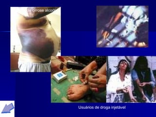Portador de cirrose alcoólica Usuários de droga injetável 