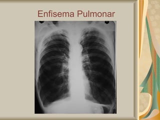 Enfisema Pulmonar 