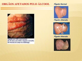 ORGÃOS AFETADOS PELO ÁLCOOL FÍgado Normal
FÍgado Alterado
FÍgado Alterado
 