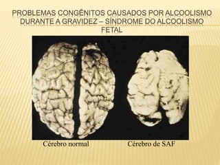 PROBLEMAS CONGÊNITOS CAUSADOS POR ALCOOLISMO
DURANTE A GRAVIDEZ – SÍNDROME DO ALCOOLISMO
FETAL
Cérebro normal Cérebro de SAF
 