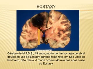 ECSTASY
Cérebro de M.P.S.S., 19 anos, morta por hemorragia cerebral
devido ao uso de Ecstasy durante festa rave em São José do
Rio Preto, São Paulo. A morte ocorreu 40 minutos após o uso
do Ecstasy.
 