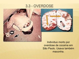 3.3 - OVERDOSE
Indivíduo morto por
overdose de cocaína em
São Paulo. Usava também
maconha.
 