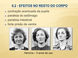 6.2 - EFEITOS NO RESTO DO CORPO
contração acentuada da pupila
paralisia do estômago
paralisia intestinal
forte prisão de ventre
Heroína – 5 anos de uso
 