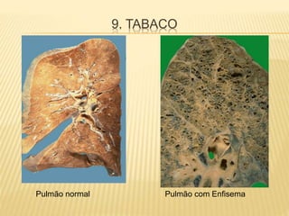 9. TABACO
Pulmão normal Pulmão com Enfisema
 