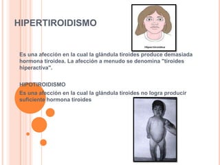 HIPERTIROIDISMOEs una afección en la cual la glándula tiroides produce demasiada hormona tiroidea. La afección a menudo se denomina "tiroides hiperactiva".HIPOTIROIDISMOEs una afección en la cual la glándula tiroides no logra producir suficiente hormona tiroides