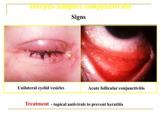 Herpes simplex conjunctivitis
Treatment
Unilateral eyelid vesicles Acute follicular conjunctivitis
- topical antivirals to prevent keratitis
Signs
 