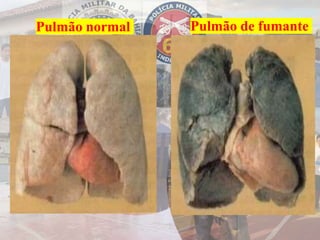 Pulmão normal Pulmão de fumante
 