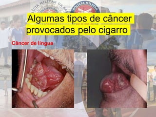 Algumas tipos de câncer
provocados pelo cigarro
Câncer de língua
 