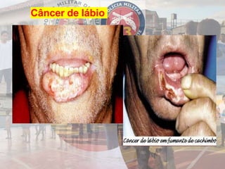 Câncer de lábio
 