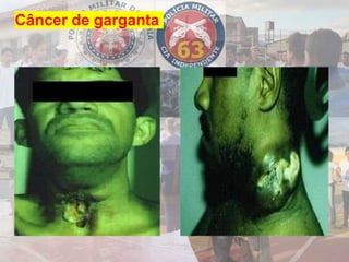 Câncer de garganta
 