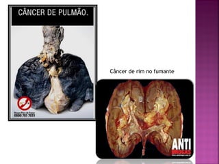 Câncer de rim no fumante
 